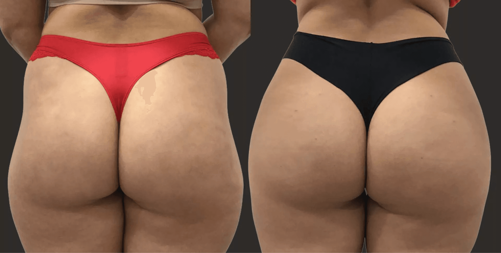 Hip Enhancement (Sculptra) before and after result