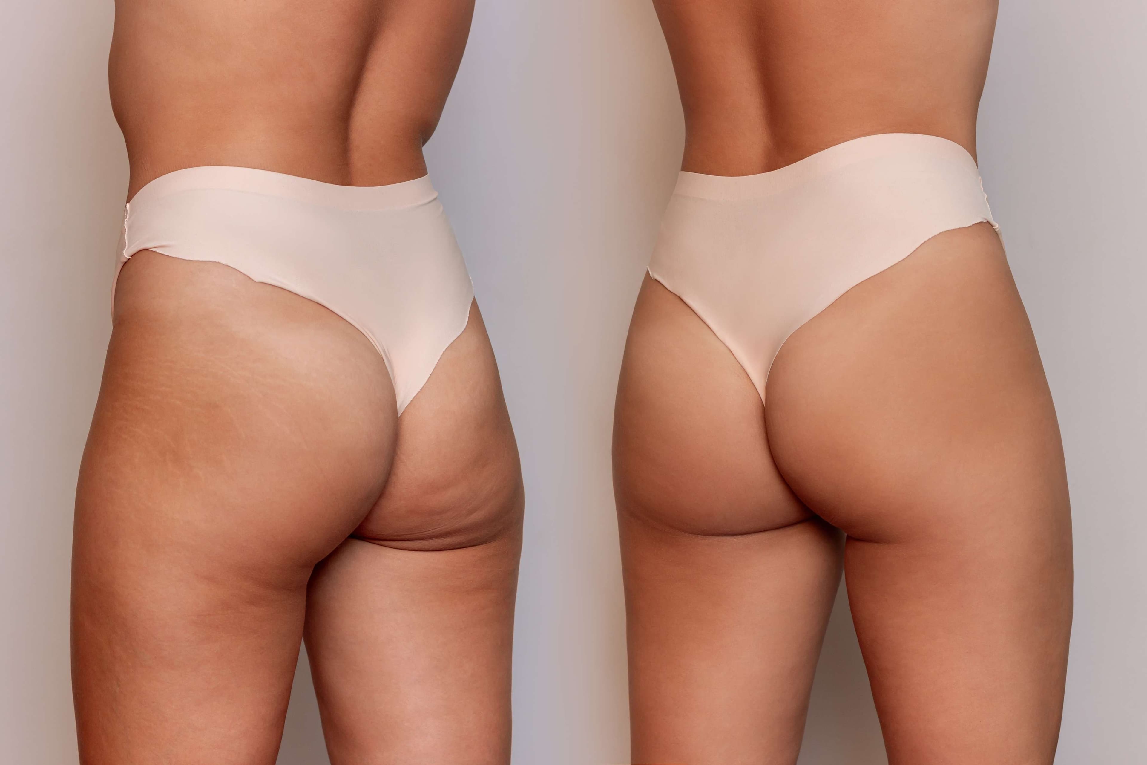 Thigh Lift/Thigh Liposuction before and after result