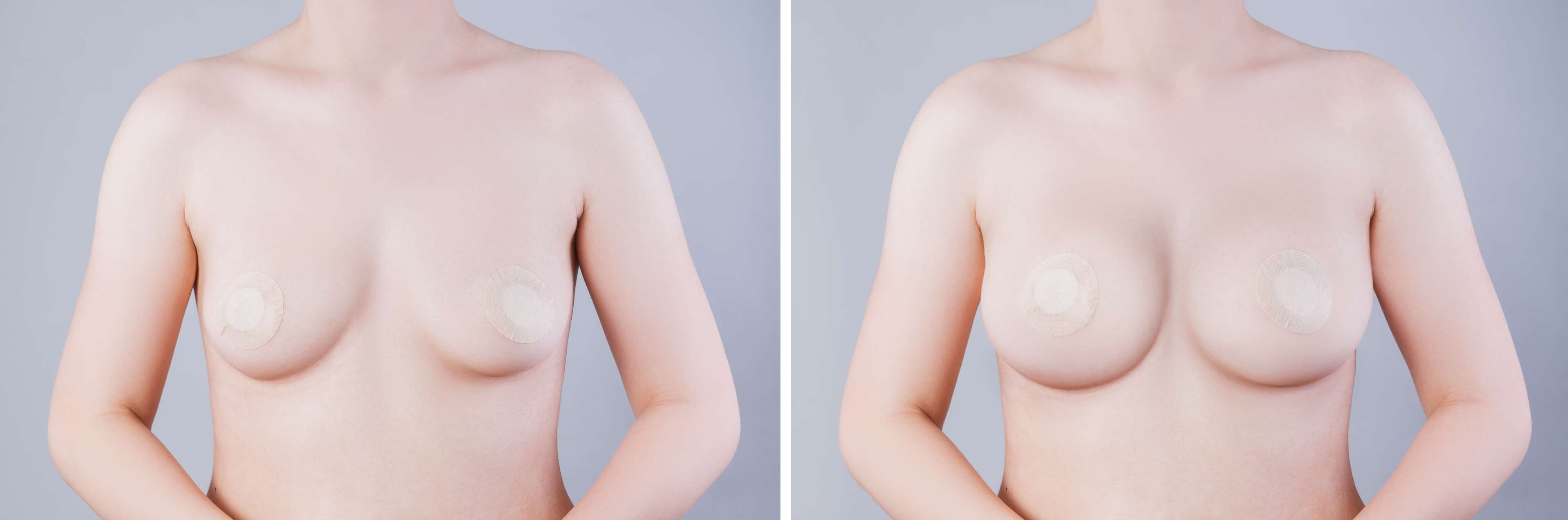 Breast Augmentation before and after result