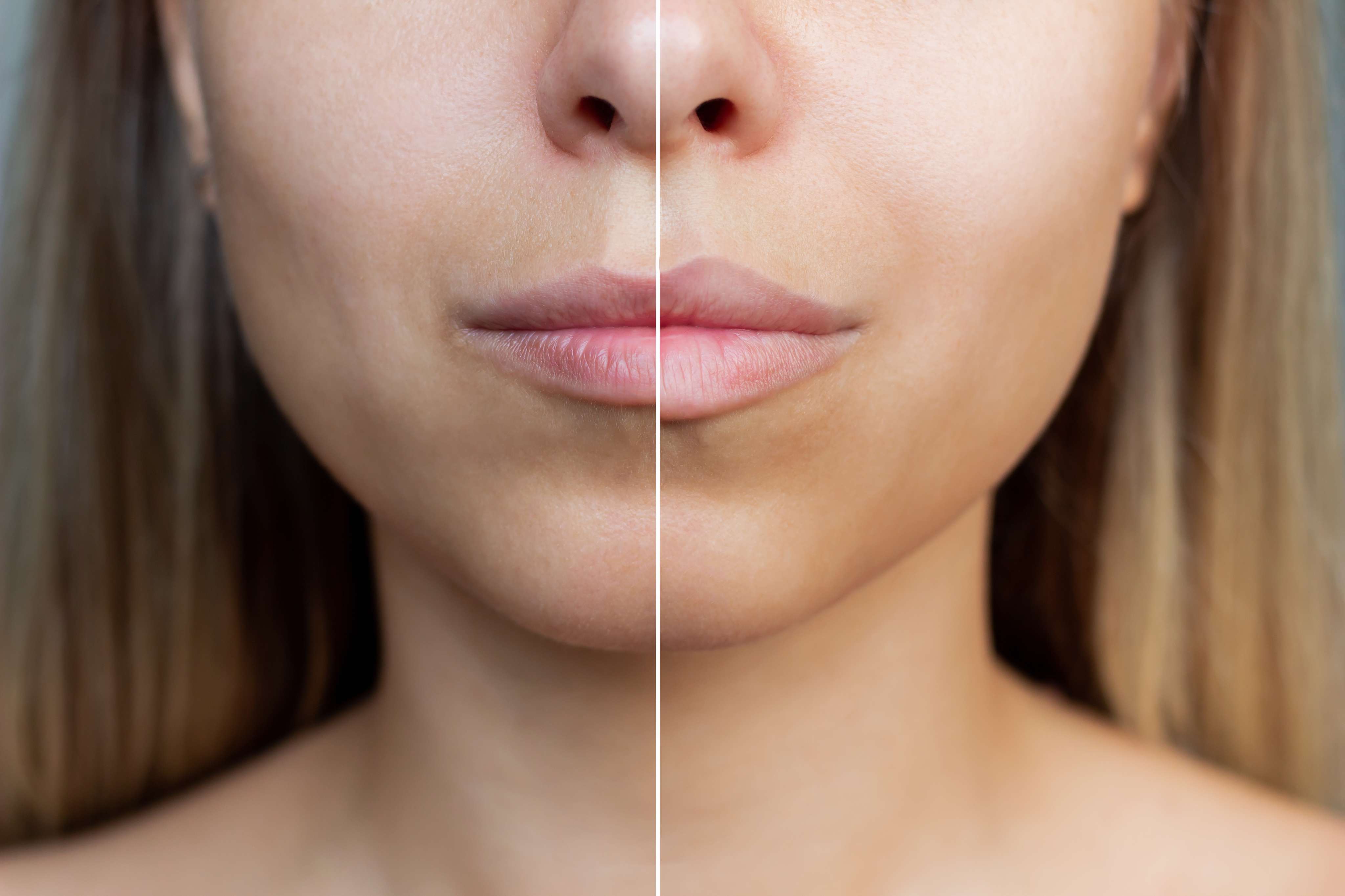 Contouring Fillers & Injectables before and after result