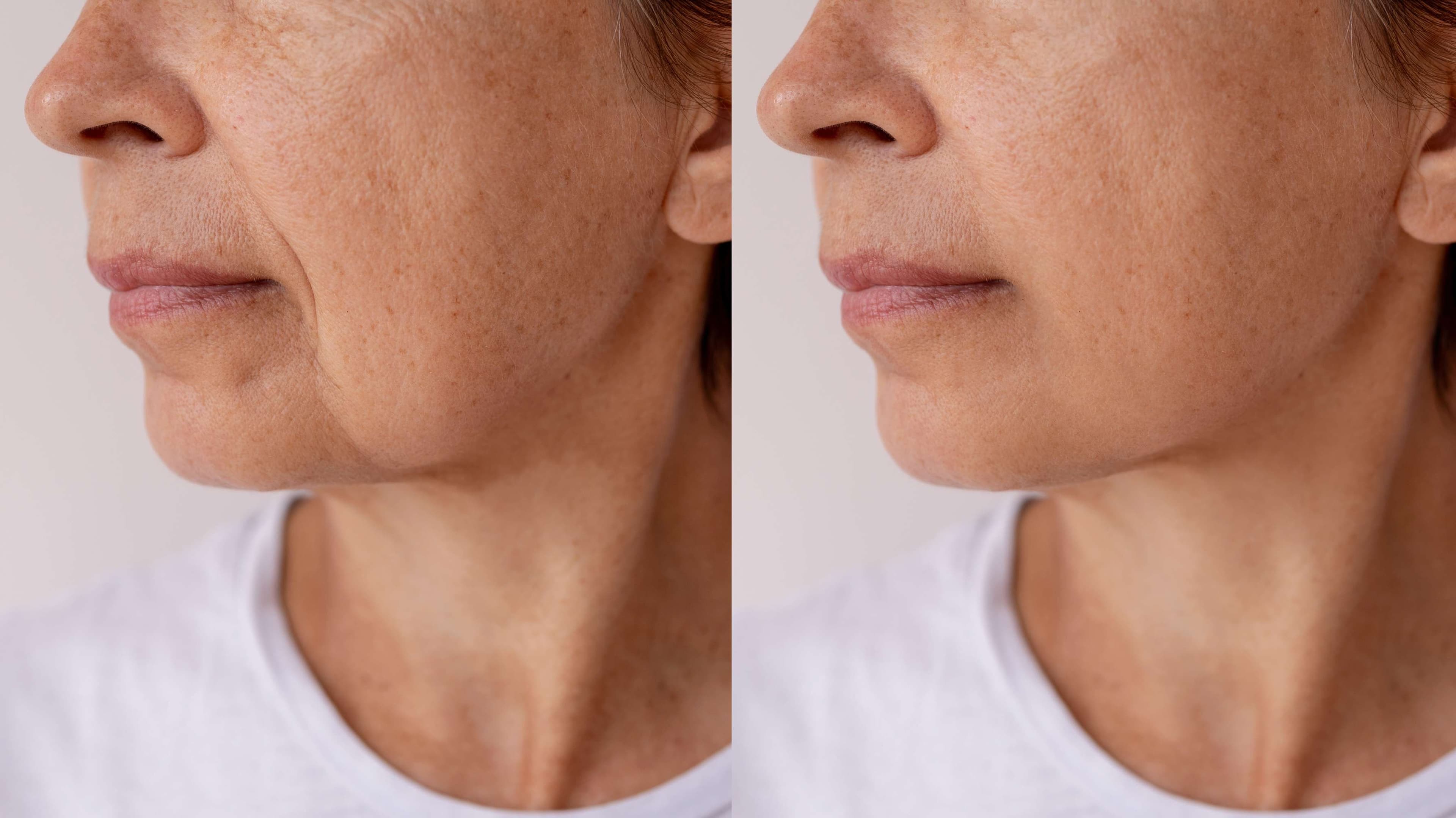 Facelift (Rhytidectomy) before and after result