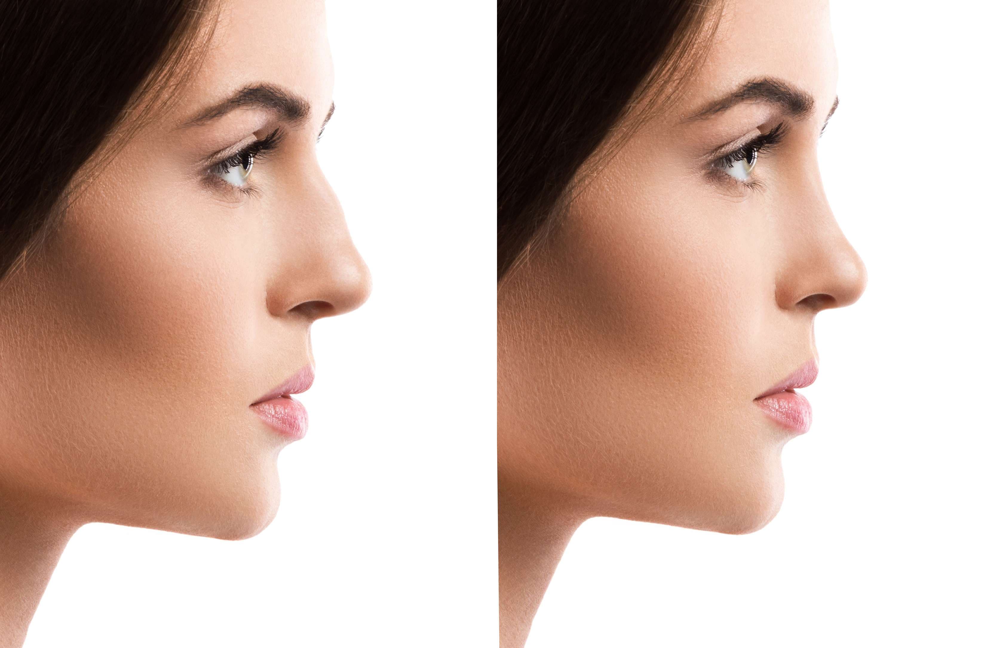 Rhinoplasty (Nose Job) before and after result