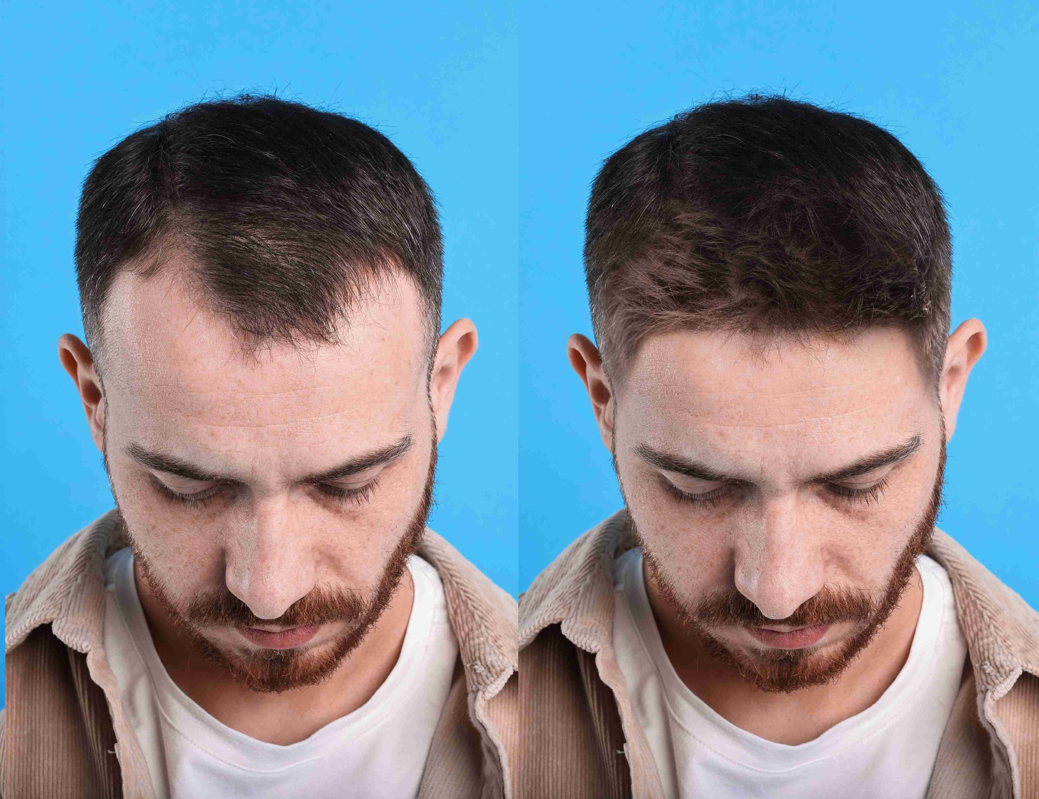 Hair Transplant / Restoration (FUE, FUT) before and after result