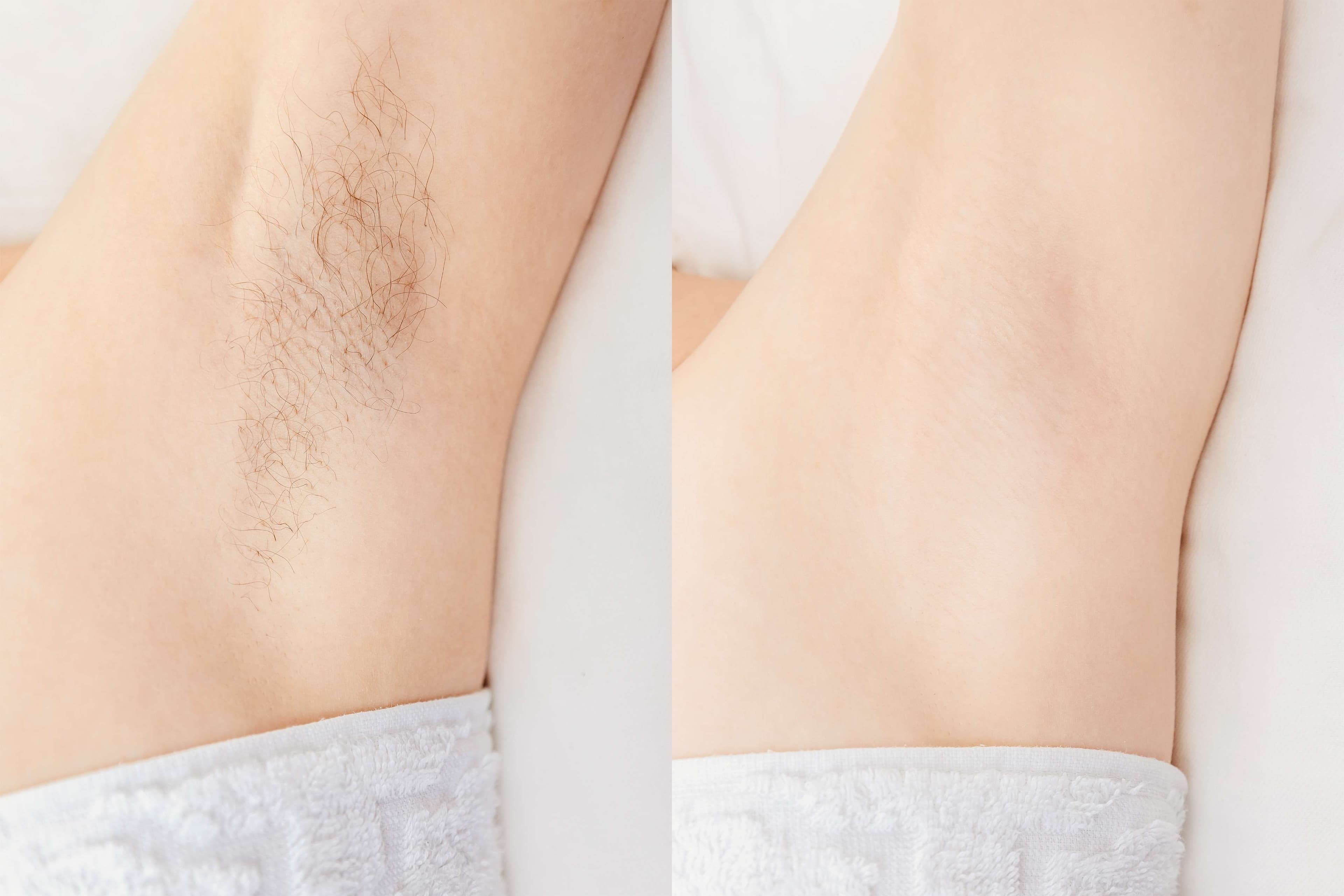 Laser Hair Removal before and after result