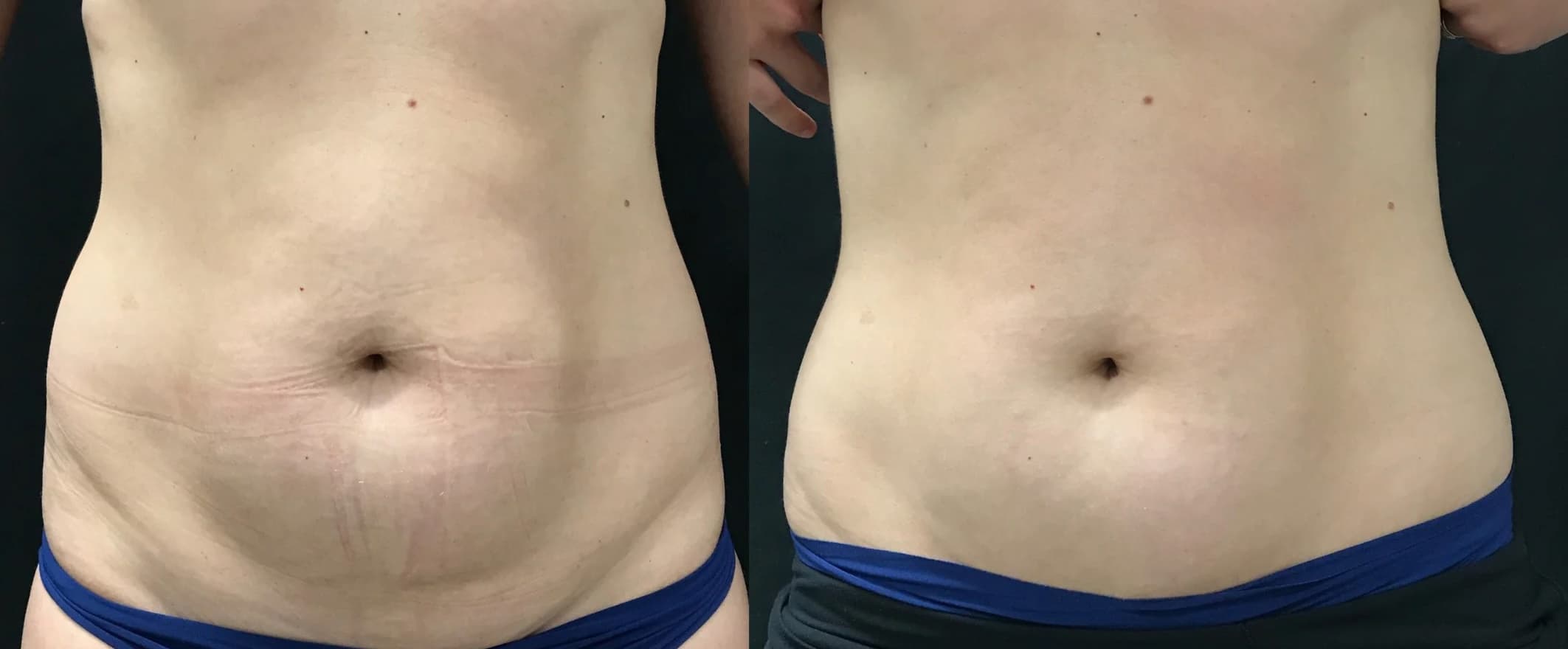 Body Radiofrequency Treatments before and after result