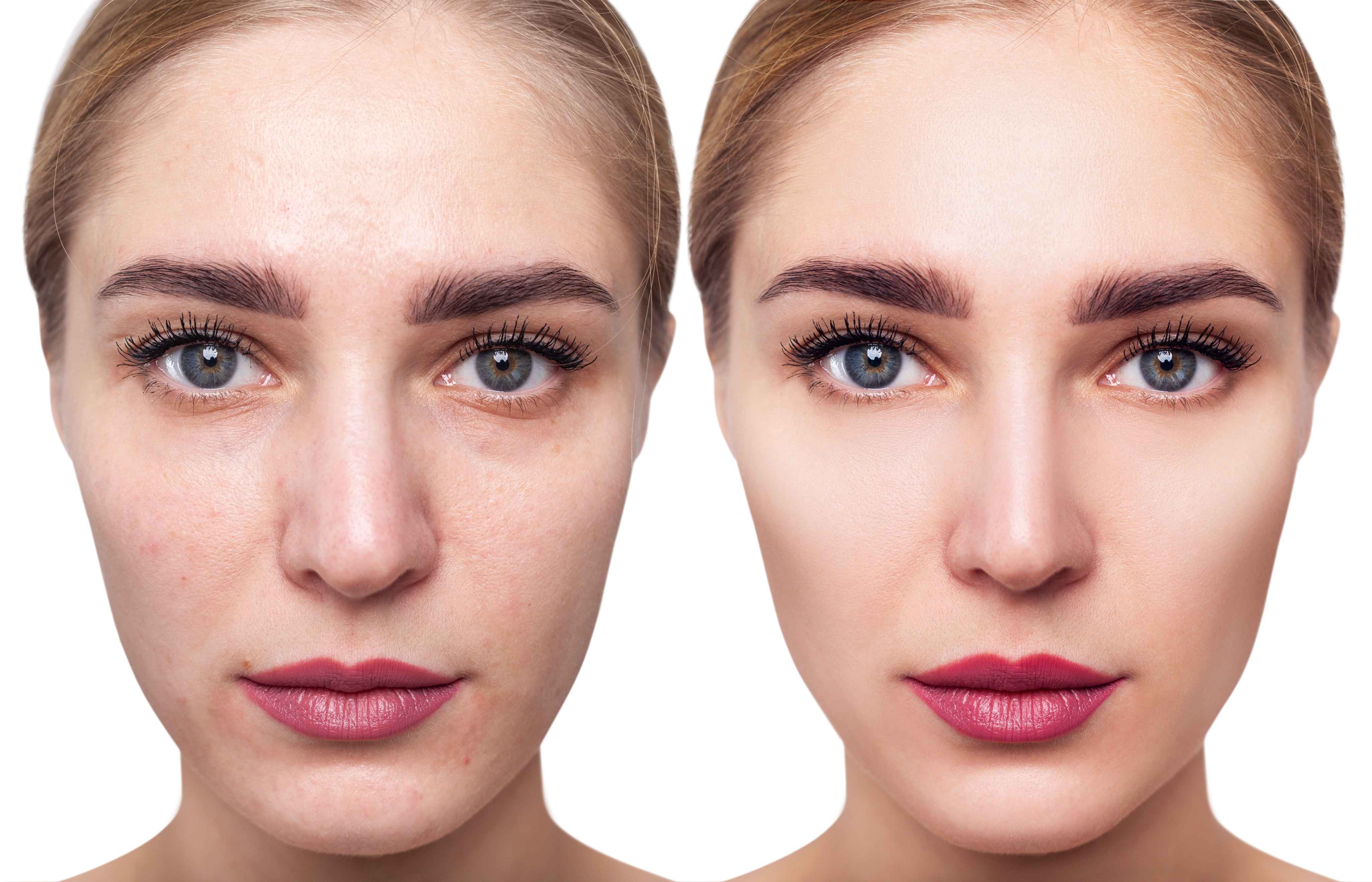 Skin Rejuvenation & Resurfacing before and after result