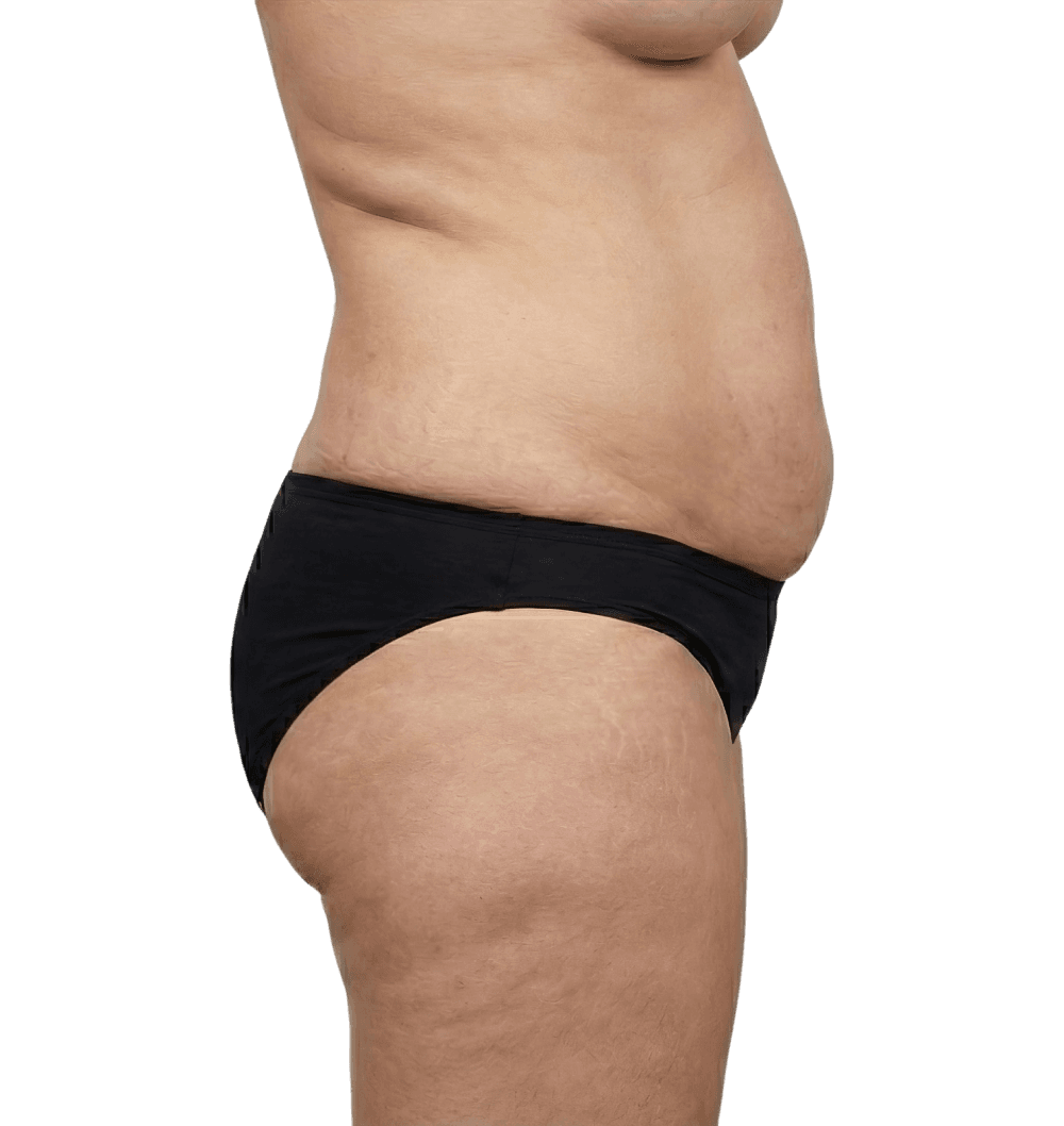 Tummy Tuck before