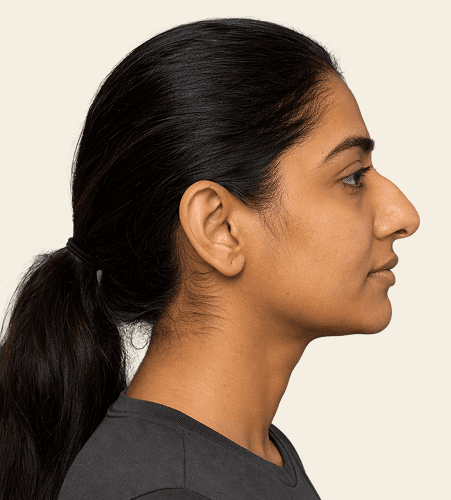 Rhinoplasty before