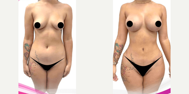 Mommy Makeover procedure image