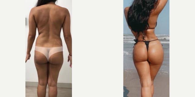 Skin Tightening procedure image