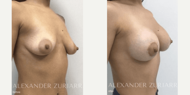 Mommy Makeover procedure image