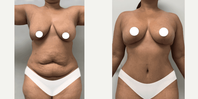 Mommy Makeover procedure image