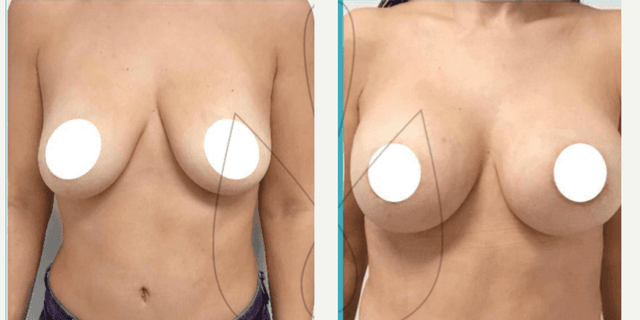 Breast Augmentation procedure image