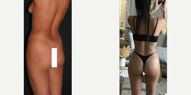 Body Lift procedure image