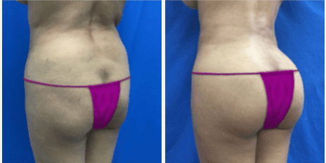 Brazilian Butt Lift (BBL) procedure image