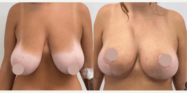Mommy Makeover procedure image