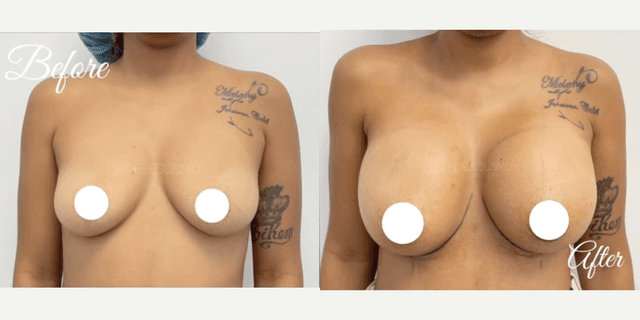 Breast Augmentation procedure image