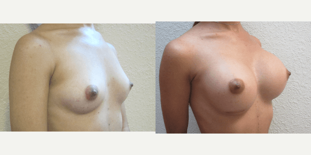Breast Augmentation procedure image