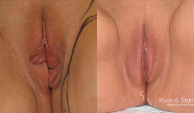 Vaginal Rejuvenation procedure image