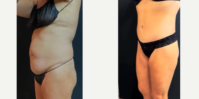 Breast Lift (Mastopexy) procedure image