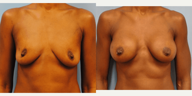 Mommy Makeover procedure image