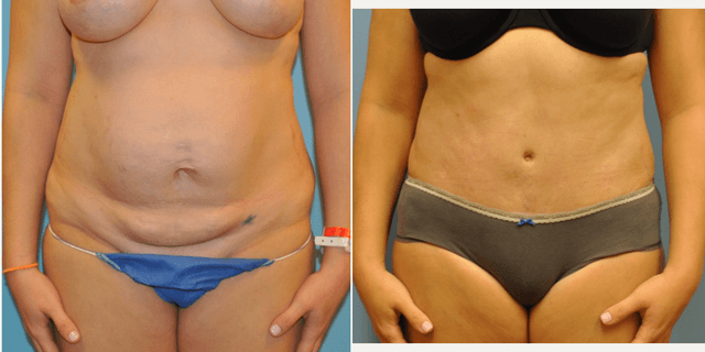 Tummy Tuck (Abdominoplasty) procedure image