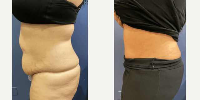 Skin Tightening procedure image