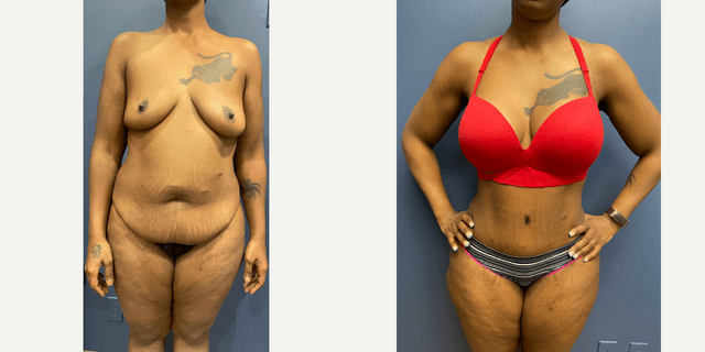 Mommy Makeover procedure image