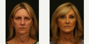 Facelift procedure image