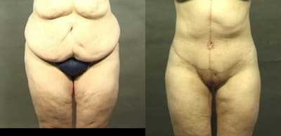 Mommy Makeover procedure image