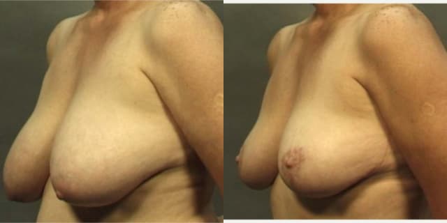Breast Augmentation procedure image
