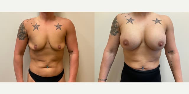 Mommy Makeover procedure image