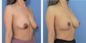 Mommy Makeover procedure image