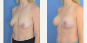 Breast Augmentation procedure image