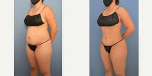 Skin Tightening procedure image