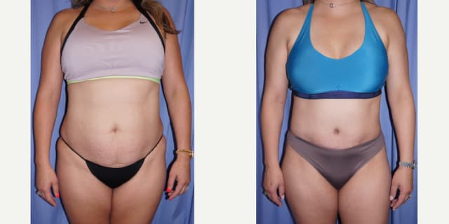 Tummy Tuck (Abdominoplasty) procedure image