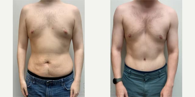 Mommy Makeover procedure image