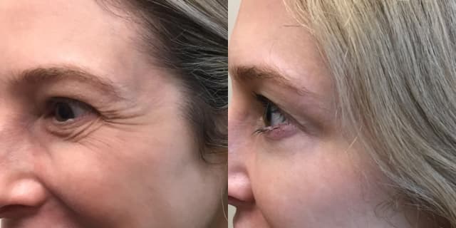 Fillers & Injectables (e.g. Botox, Juvederm) procedure image