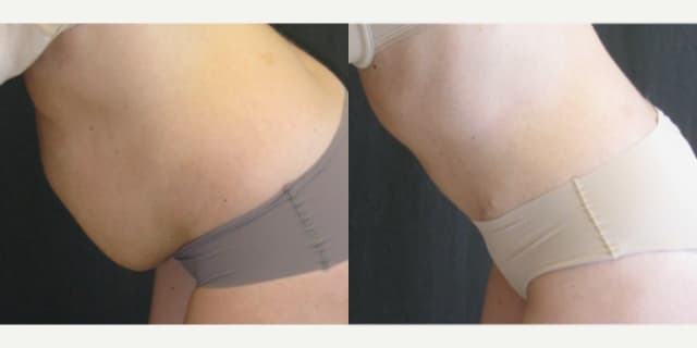 Tummy Tuck (Abdominoplasty) procedure image