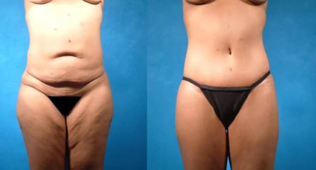 Mommy Makeover procedure image