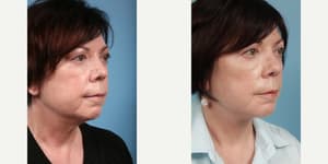 Chin Implant procedure image