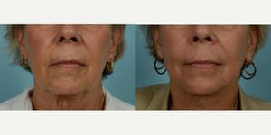 Facelift procedure image