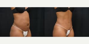 Mommy Makeover procedure image