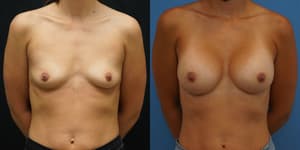 Breast Augmentation procedure image