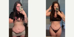 Mommy Makeover procedure image