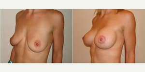 Skin Tightening procedure image