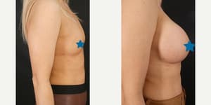 Breast Augmentation procedure image