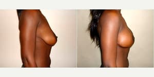 Mommy Makeover procedure image