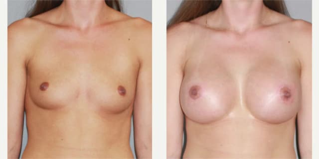 Breast Augmentation procedure image