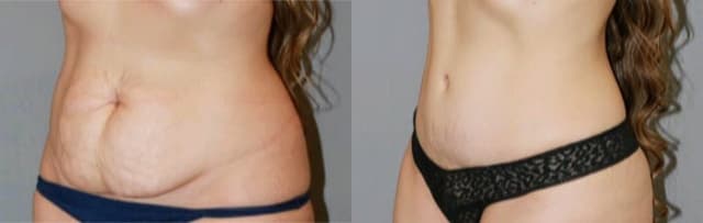 Mommy Makeover procedure image